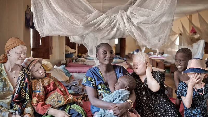 Albinoların hayatları tehlikede: Kaçırılıyor, vücutları parçalanıyor, iksir yapımı için ritüellerde kurban ediliyorlar