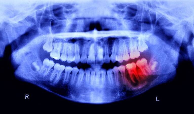 Diş mucizesi: İnsanlar yeniden diş çıkarabilecek