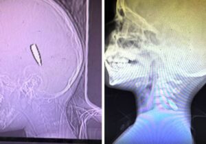 65 doktor, hemşire ve sağlık görevlisi Gazze’de gördüklerini anlattı: Kafasından vurulmuş 18 aylık bebek, ölmeyi isteyen çocuklar ve açlık…