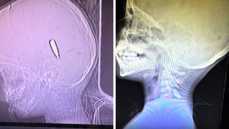 65 doktor, hemşire ve sağlık görevlisi Gazze’de gördüklerini anlattı: Kafasından vurulmuş 18 aylık bebek, ölmeyi isteyen çocuklar ve açlık…