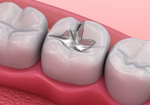 Ülkeler 2034’e kadar cıva bazlı diş dolgularını sonlandırma kararı aldı