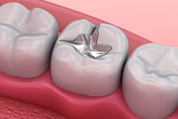 Ülkeler 2034’e kadar cıva bazlı diş dolgularını sonlandırma kararı aldı